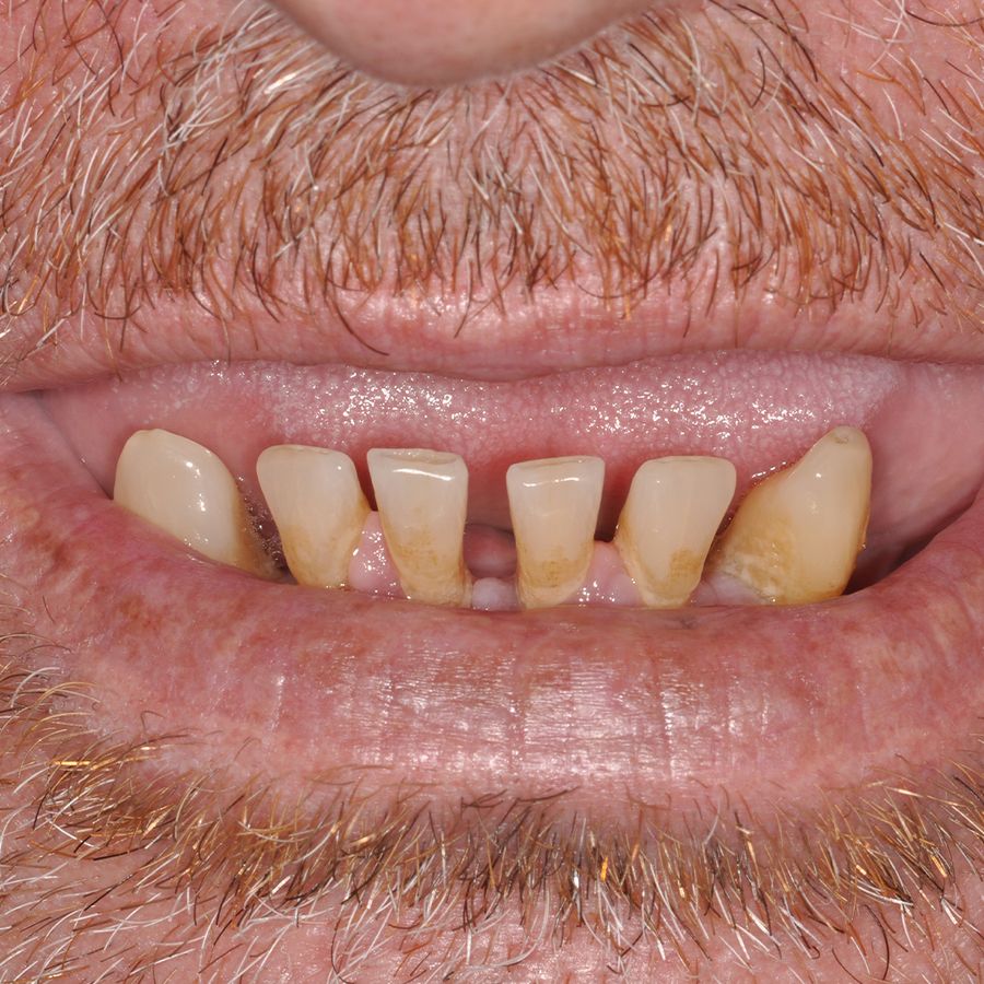 smile in a day before smile 13 - 3Dental
